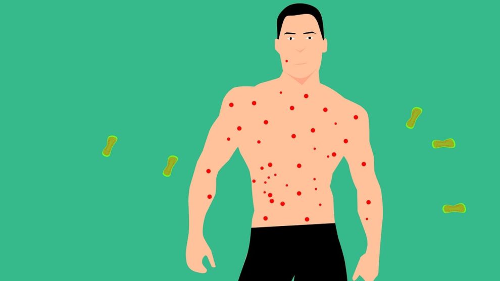 Wie lange ist die Inkubationszeit bei Affenpocken? - Affenpocken.de